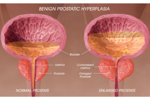 BPH