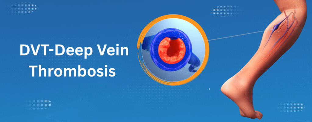 Deep vein thrombosis