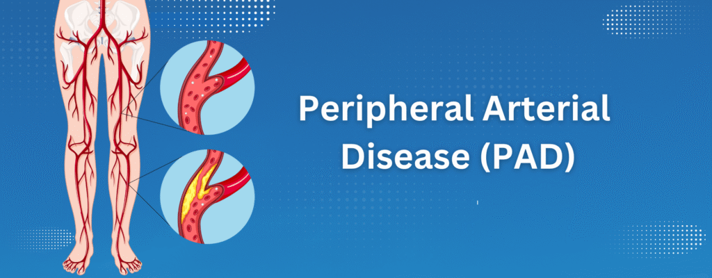 Peripheral Artery Disease