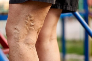 Varicose Veins