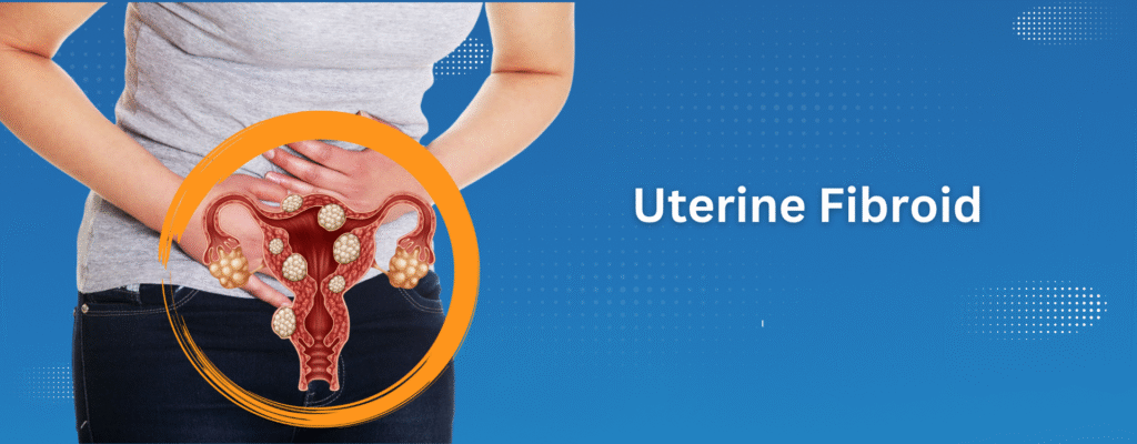 Uterine fibroid