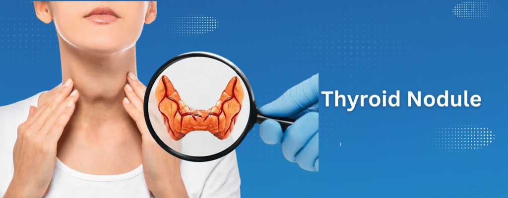 Thyroid nodule